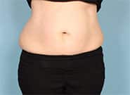 After Image: Umbilical Hernia Repair with Duramesh - front