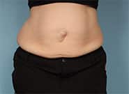 Before Image: Umbilical Hernia Repair with Duramesh - front