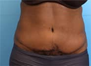 After Image: Abdominal tumor removal and abdominoplasty with Duramesh - front