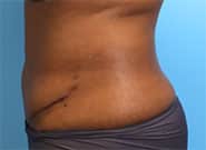 After Image: Abdominal tumor removal and abdominoplasty with Duramesh - left-side