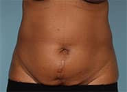 Before Image: Abdominal tumor removal and abdominoplasty with Duramesh - front