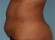 Before Image: Abdominal tumor removal and abdominoplasty with Duramesh - left-side