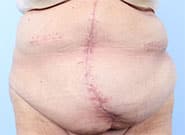 After Image: 16 cm wide hernia treated with Duramesh - front