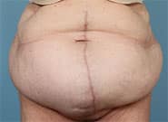 Before Image: 16 cm wide hernia treated with Duramesh - front