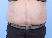 After Image: 10 cm wide hernia treated with Duramesh - front