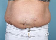 Before Image: 10 cm wide hernia treated with Duramesh - front