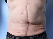 After Image: Massive hernia repaired with preoperative botox, pneumoperitoneum, Duramesh - front