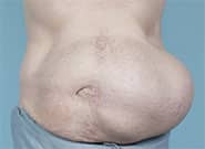 Before Image: Massive hernia repaired with preoperative botox, pneumoperitoneum, Duramesh - front