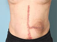After Image: Ostomy takedown and parastomal hernia repair with bowel surgery and Duramesh - front