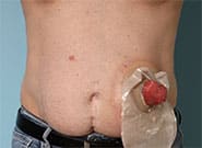 Before Image: Ostomy takedown and parastomal hernia repair with bowel surgery and Duramesh - front