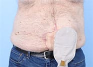 After Image: Stoma relocation and 12 cm hernia repair with Duramesh - front