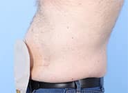 After Image: Stoma relocation and 12 cm hernia repair with Duramesh - left-side