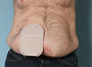 Before Image: Stoma relocation and 12 cm hernia repair with Duramesh - front