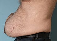 Before Image: Stoma relocation and 12 cm hernia repair with Duramesh - left-side