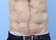 After Image: 13 cm wide hernia repaired with anterior components release and Duramesh - front