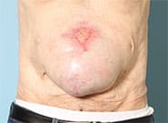 Before Image: 13 cm wide hernia repaired with anterior components release and Duramesh - front