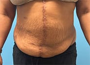After Image: Infected kidney removal and 9 cm wide hernia repaired with anterior components release and Duramesh - front