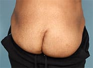 Before Image: Infected kidney removal and 9 cm wide hernia repaired with anterior components release and Duramesh - front