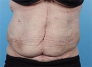 After Image: Fistula and exposed hernia mesh treated with bowel repair and Duramesh - front