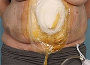 Before Image: Fistula and exposed hernia mesh treated with bowel repair and Duramesh - front
