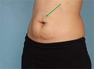After Image: Epigastric Hernia Repair with Duramesh - front
