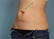 Before Image: Epigastric Hernia Repair with Duramesh - front