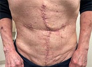 After Image: Patient with colocutaneous fistula and 10 cm wide hernia treated with bowel repair, anterior components release, and Duramesh - front