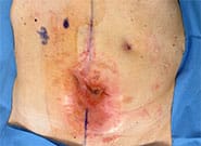 Before Image: Patient with colocutaneous fistula and 10 cm wide hernia treated with bowel repair, anterior components release, and Duramesh - front