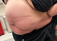 After Image: Incarcerated umbilical hernia repair with Duramesh - left-front-oblique