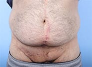 After Image: Inguinal hernia repair with Duramesh - front