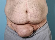 Before Image: Inguinal hernia repair with Duramesh - front