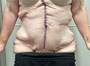 After Image: Massive 15 cm wide hernia repaired with anterior components release, Duramesh, and vertical abdominoplasty - front