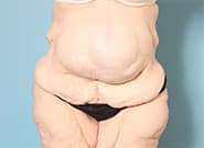 Before Image: Massive 15 cm wide hernia repaired with anterior components release, Duramesh, and vertical abdominoplasty - front