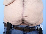 After Image: 300 lb weight loss, 3 hernias. All repaired with #2 Duramesh - front