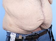 After Image: 300 lb weight loss, 3 hernias. All repaired with #2 Duramesh - right-front-oblique