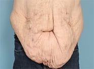 Before Image: 300 lb weight loss, 3 hernias. All repaired with #2 Duramesh - front
