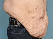 Before Image: 300 lb weight loss, 3 hernias. All repaired with #2 Duramesh - right-front-oblique
