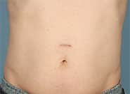 After Image: Epigastric Hernia Repair with Duramesh - front