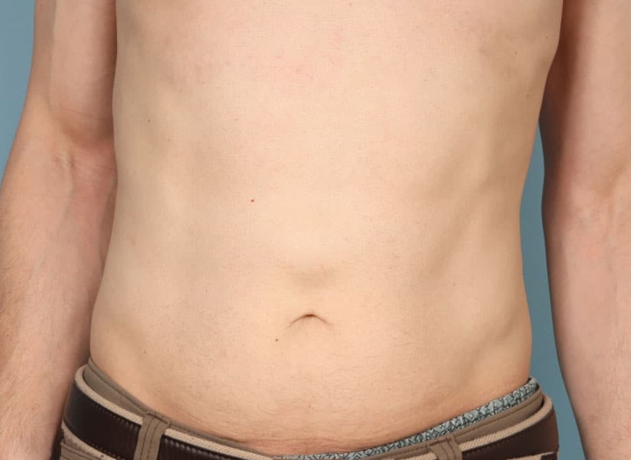 Before Image: Epigastric Hernia Repair with Duramesh - front