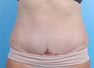 After Image: 5 cm wide hernia and abdominoplasty closed with Duramesh - front