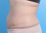 After Image: 5 cm wide hernia and abdominoplasty closed with Duramesh - left-side