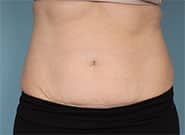 Before Image: 5 cm wide hernia and abdominoplasty closed with Duramesh - front