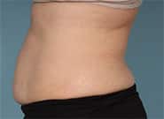Before Image: 5 cm wide hernia and abdominoplasty closed with Duramesh - left-side