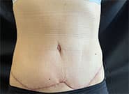 After Image: Abdominoplasty with Duramesh - front