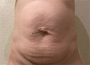 Before Image: Abdominoplasty with Duramesh - front