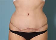 After Image: Abdominoplasty with Duramesh - front