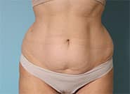 Before Image: Abdominoplasty with Duramesh - front