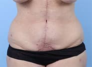 After Image: 72 year old with incisional hernia treated with Duramesh, associated abdominoplasty - front