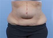 Before Image: 72 year old with incisional hernia treated with Duramesh, associated abdominoplasty - front