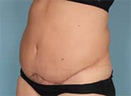 After Image: Abdominoplasty with Duramesh - front